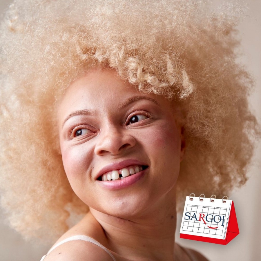 It's June 13th: World Albinism Day